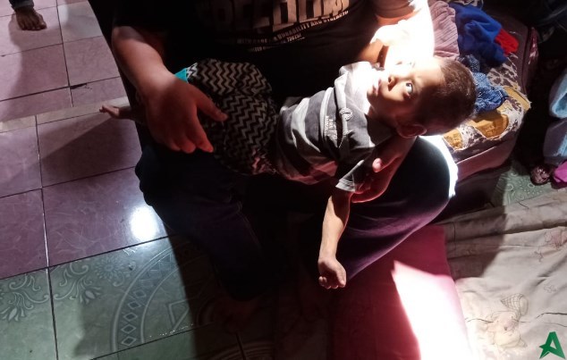 Balita menderita gizi buruk di Serang
